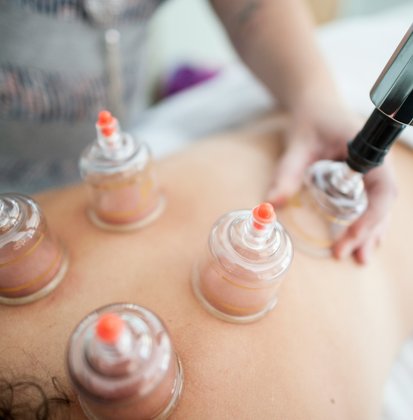 cupping therapy